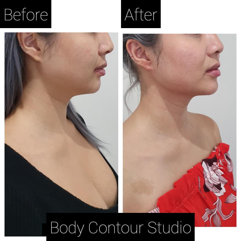 Non-invasive Body Contouring by Body Contour Studio – MySecretLashes